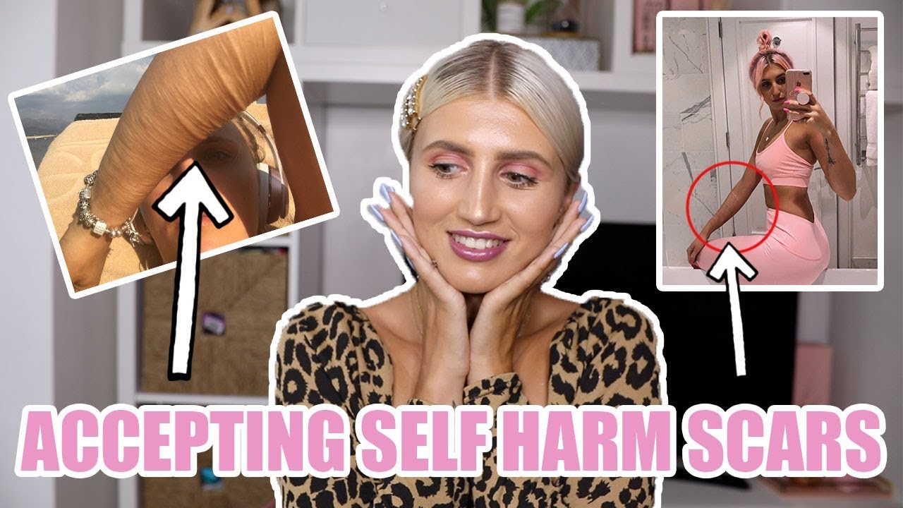 HOW TO ACCEPT YOUR SELF HARM SCARS