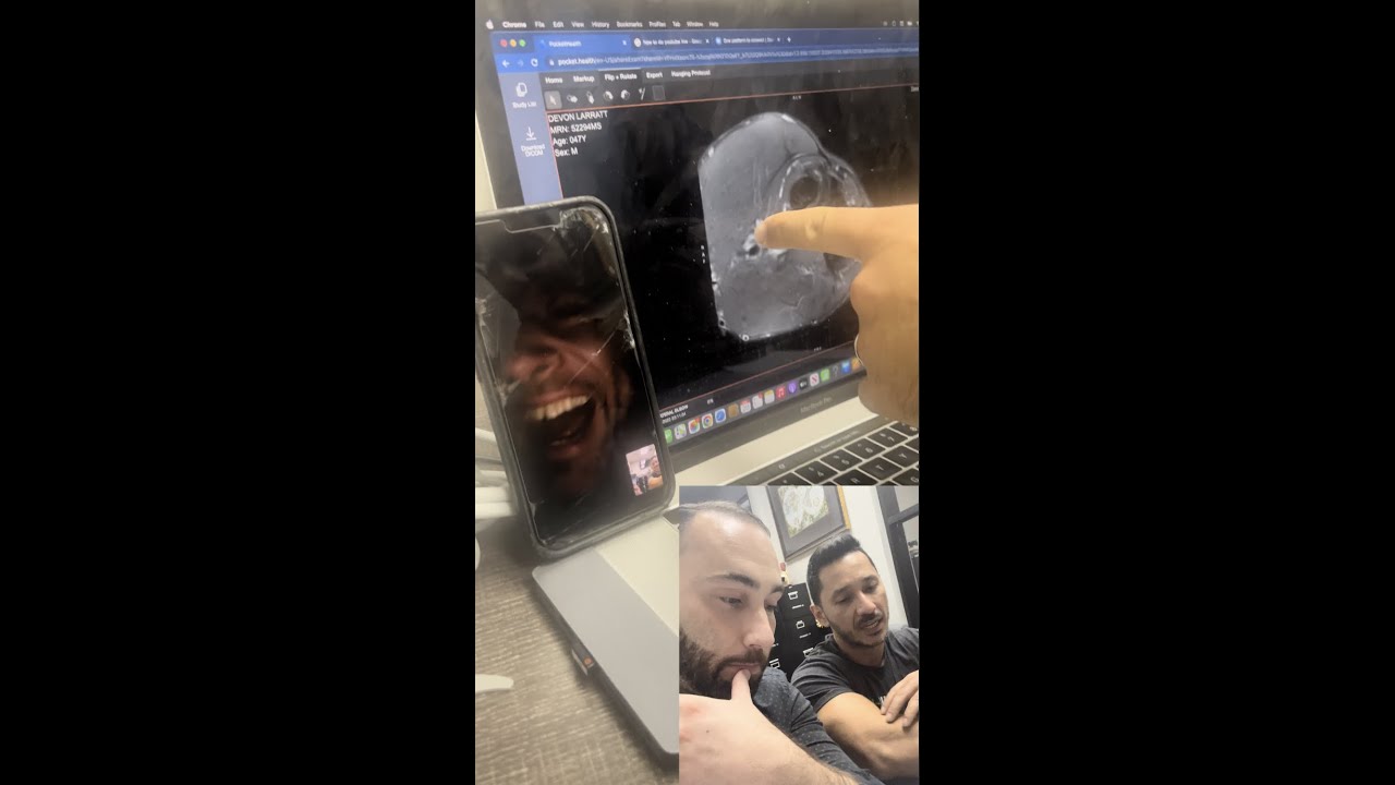 DEVON LARRATT ELBOW MRI DISCUSSION, HOW MESSED UP IS IT?!?!