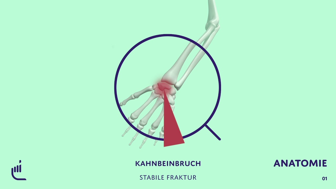 Was ist eine Kahnbeinfraktur?