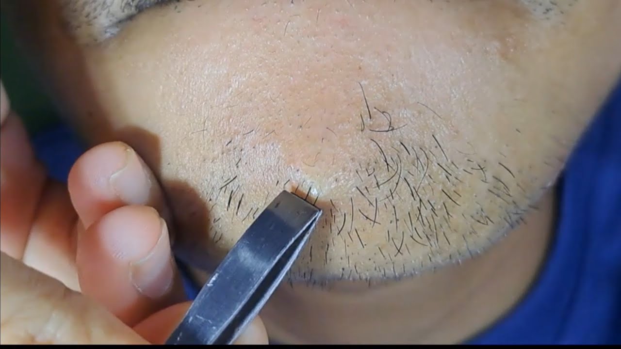 Daily Activity, kegiatan mencabut rambut dagu yang melegakan #satisfying #plucking #hairremoval #2