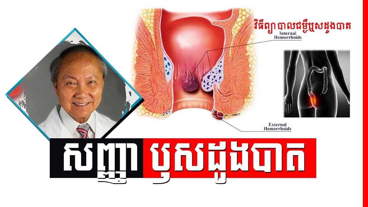 ជំងឺ​ឫសដូងបាត៖ រោគសញ្ញា និង រោគវិនិច្ឆ័យ ជំងឺ​ឫសដូងបាត , hemorrhoids symptoms