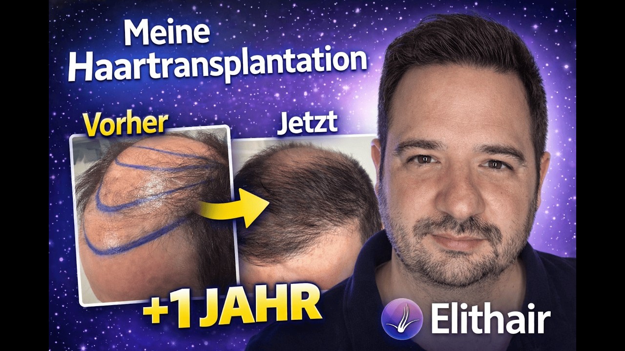 Meine Haartransplantation bei Elithair in Istanbul - Meine Erfahrung | Teil 11 - 12 Monate
