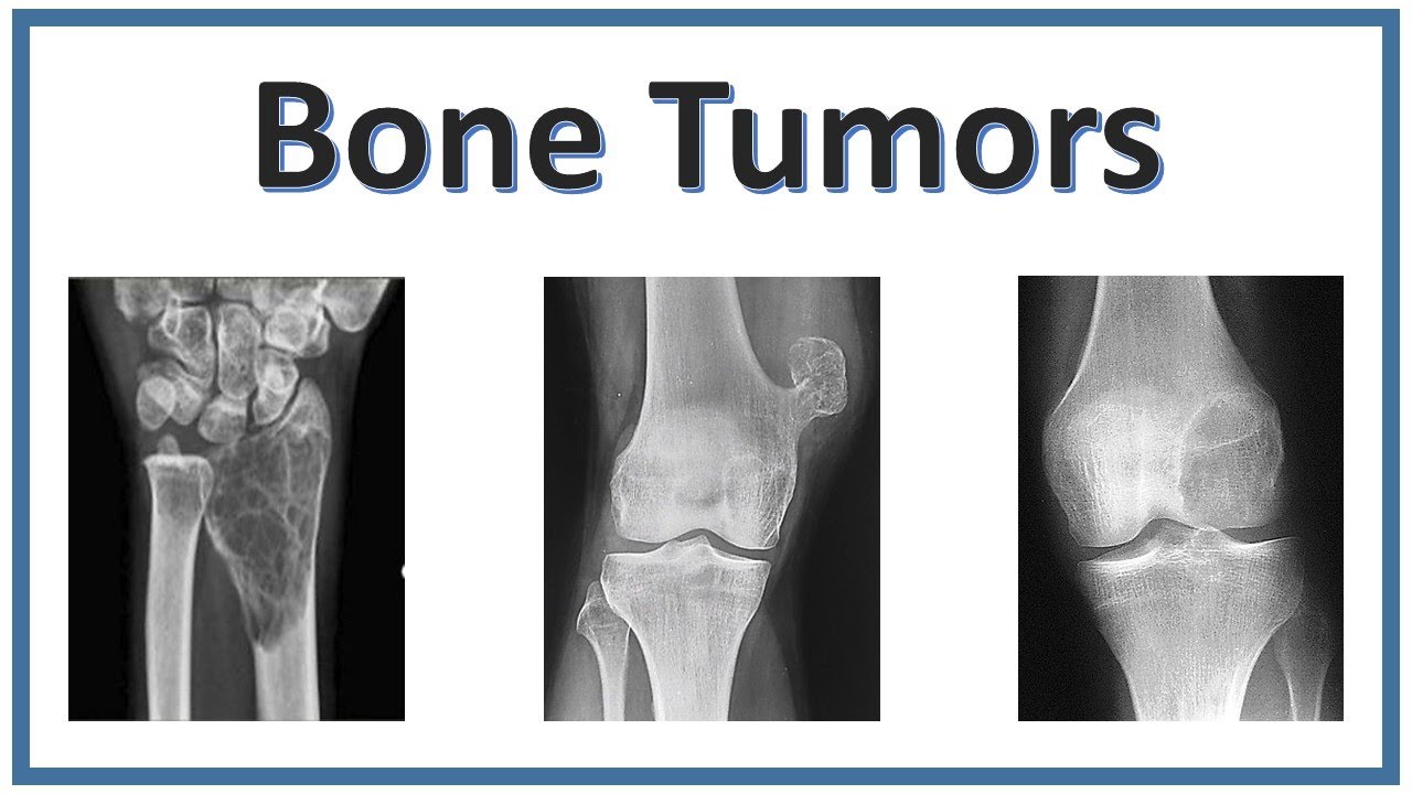 Bone Tumors | NEET PG | Must know Images and Topics