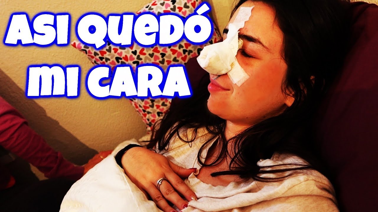 ASI QUED&Oacute; MI CARA DESPUES DE LA CAIDA *Silbiditos viene a ayudarnos*