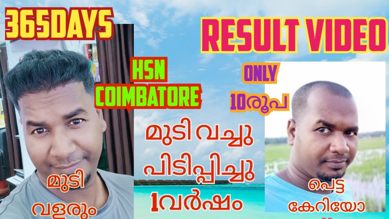 1YEAR HAIR TRANSPLANT RESULTS 💥HSN COIMBATORE 💢മുടി വച്ചുപിടിപ്പിച്ചു ഒരു വർഷം ആയപ്പോൾ റിസൾട്ട്‌ 👏🏻🙏