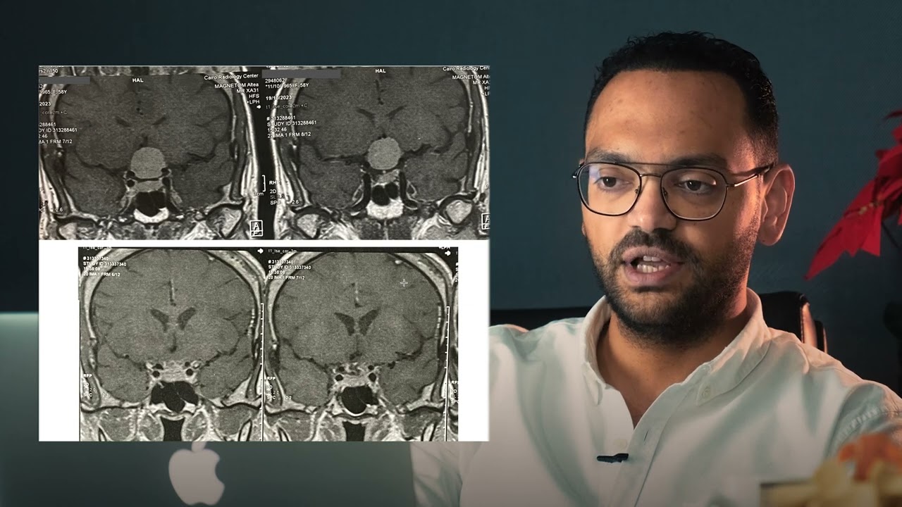 قصة علاج حالة كانت تعاني من ورم في قاع الجمجمة | دكتور خالد الشاذلي