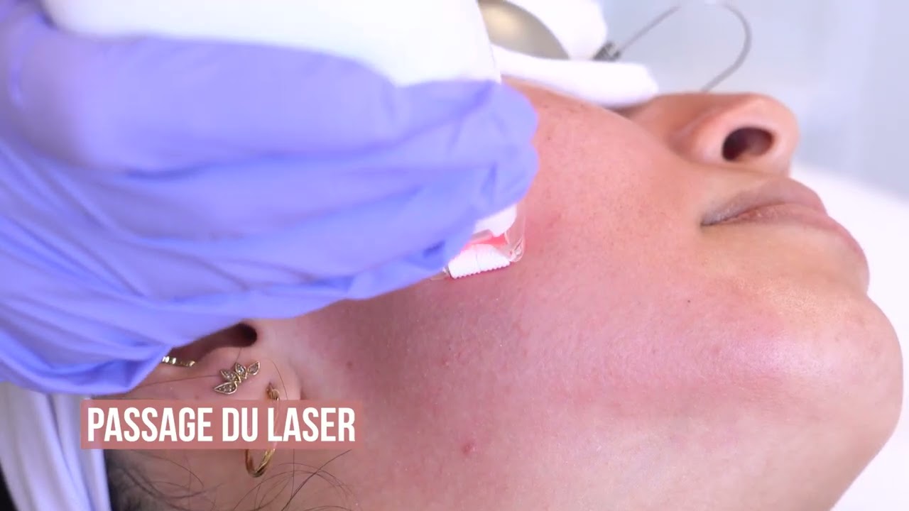 Le LaseMD Ultra