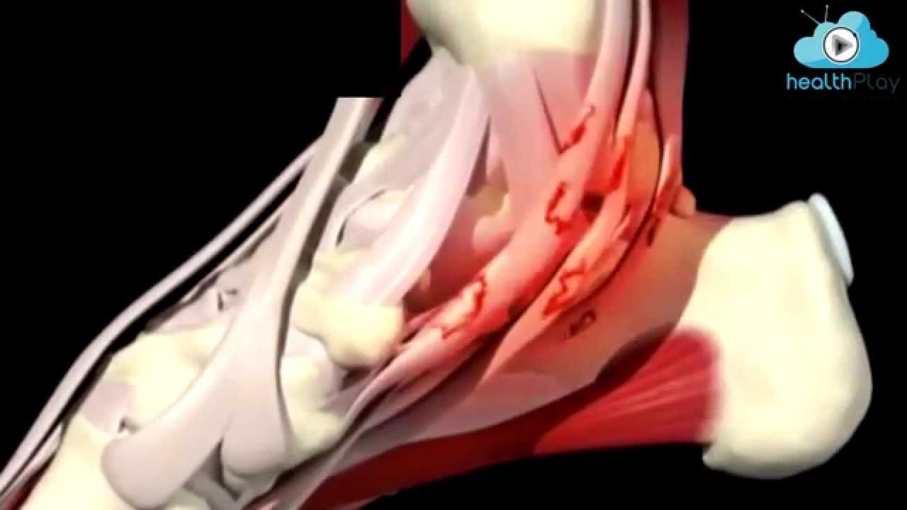 Tendinit Nedir? - Prof.Dr.Turan Uslu