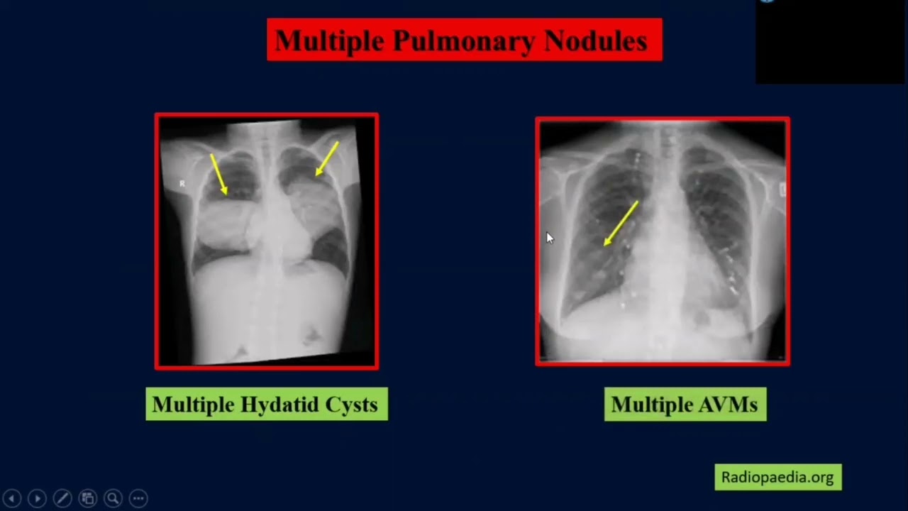 pediatric chest X_ Ray  part (ll)