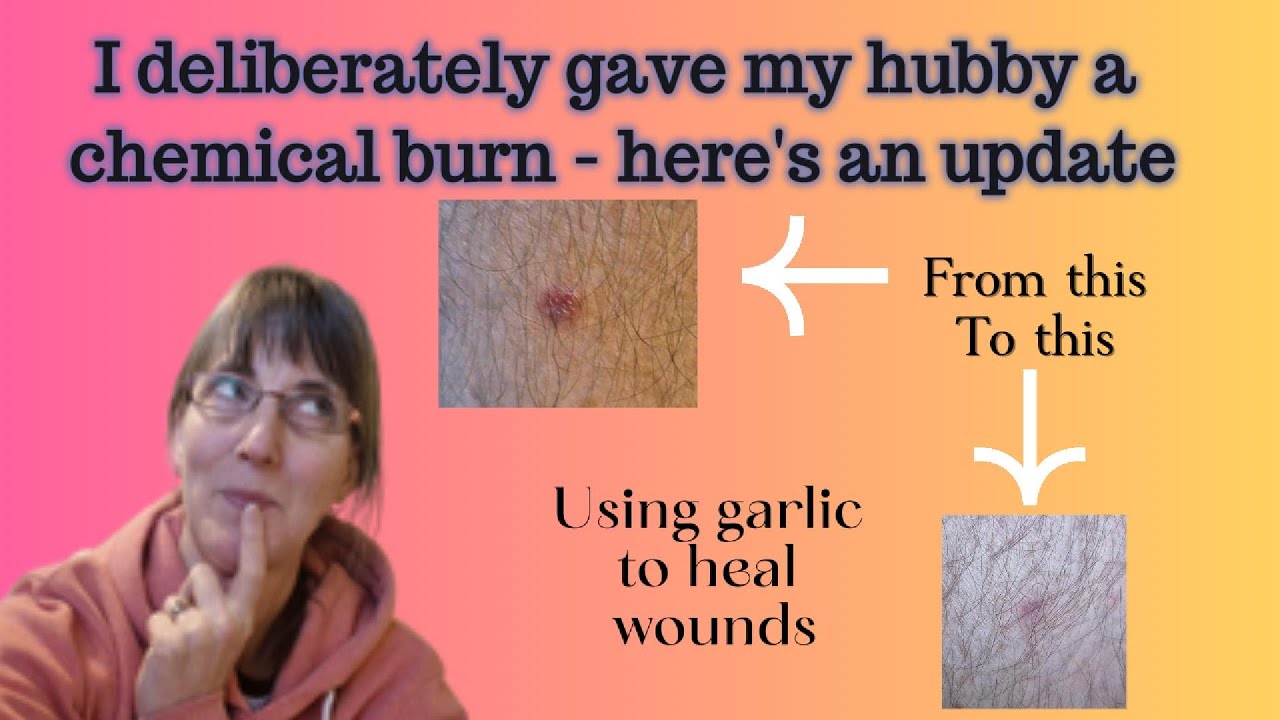 Healing with garlic? An update on a chemical burn I gave my husband to heal a wound on his leg