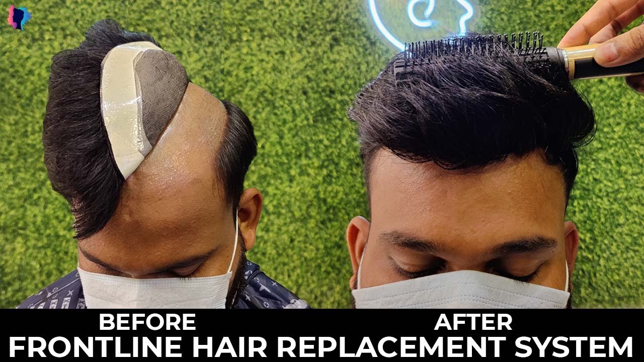 hair replacement system | frontline australian hair patch | long hair patch look #hairpatch