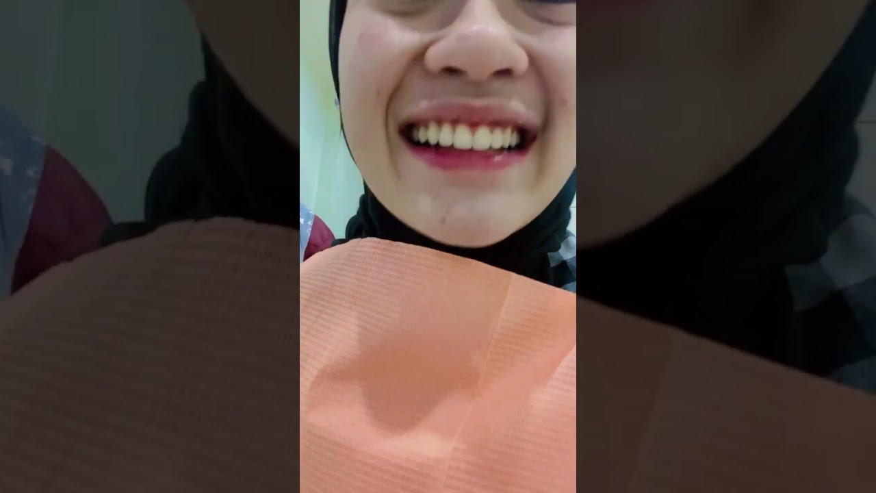 Yeay! Akhirnya lepas behel🥰✨ #LepasBehel #braces #behel
