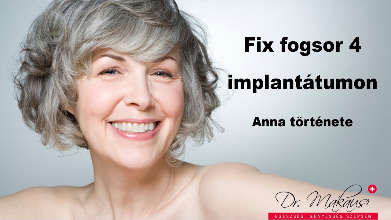 Anna t&ouml;rt&eacute;nete - Fix fogsor (fast and fixed)