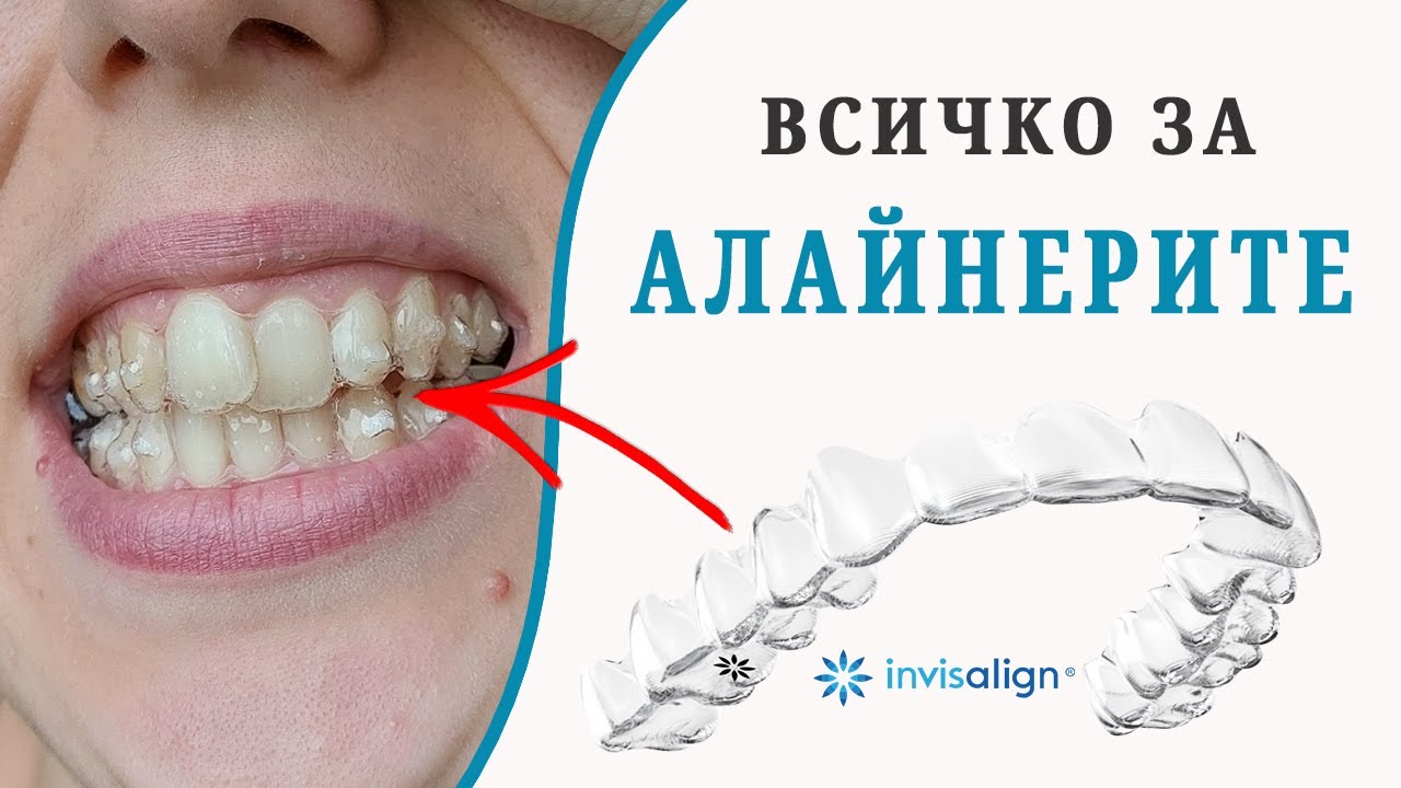 Всичко за алайнерите на Invisalign