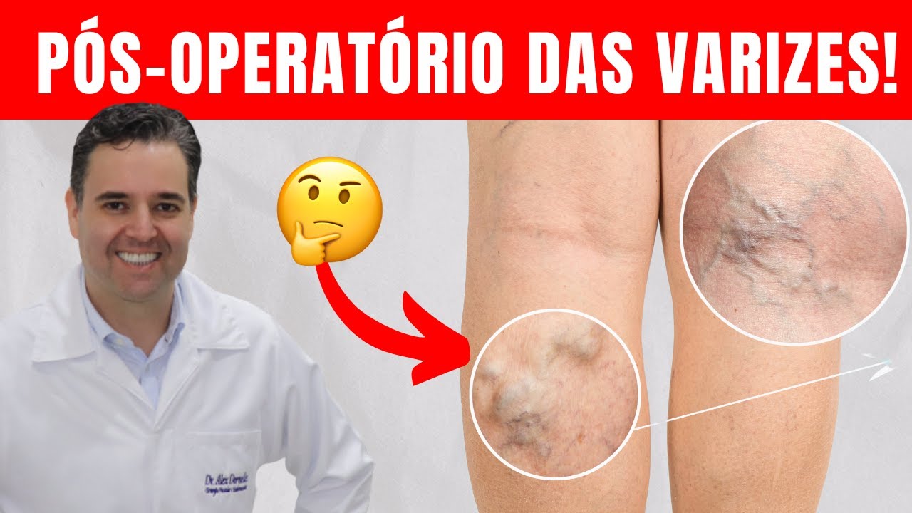 Pós-operatório do Tratamento de Varizes - Dr. Alex Vascular