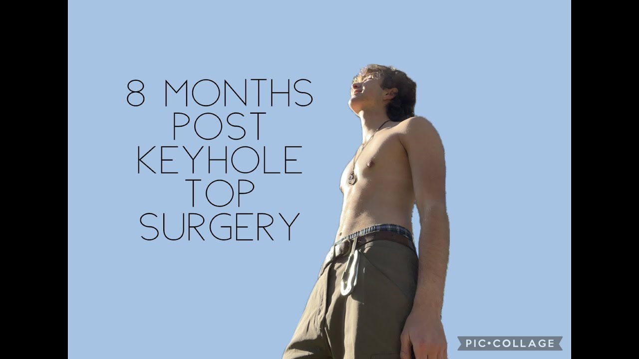 8 Months Post Keyhole FTNB Top Surgery: How I chose keyhole for my surgery.