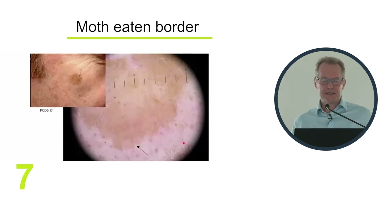 GatewayC Live: Greater Manchester – 12 Tips to Identify Seborrhoeic Keratosis