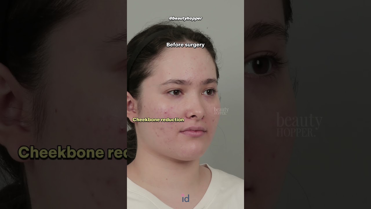 full face plastic surgery in Korea! ft. beautyhopper
