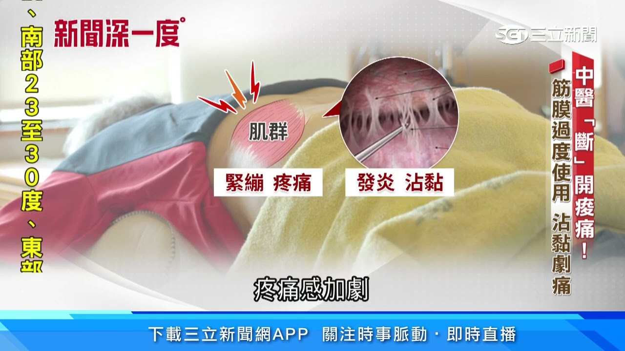 腰酸背痛困擾600萬人 「小針刀」鬆開沾黏處｜三立新聞網 SETN.com