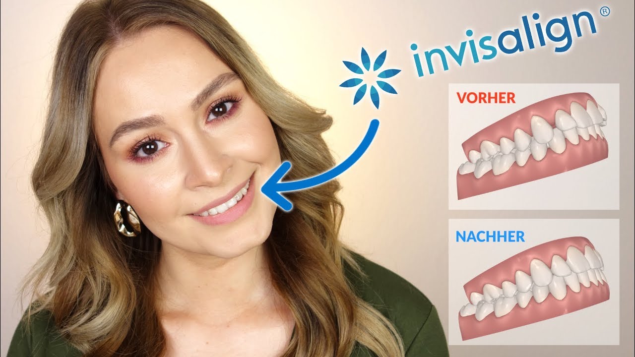 Unsichtbare Zahnspange ? 😬  INVISALIGN Kosten | Erfahrung | Schmerzen