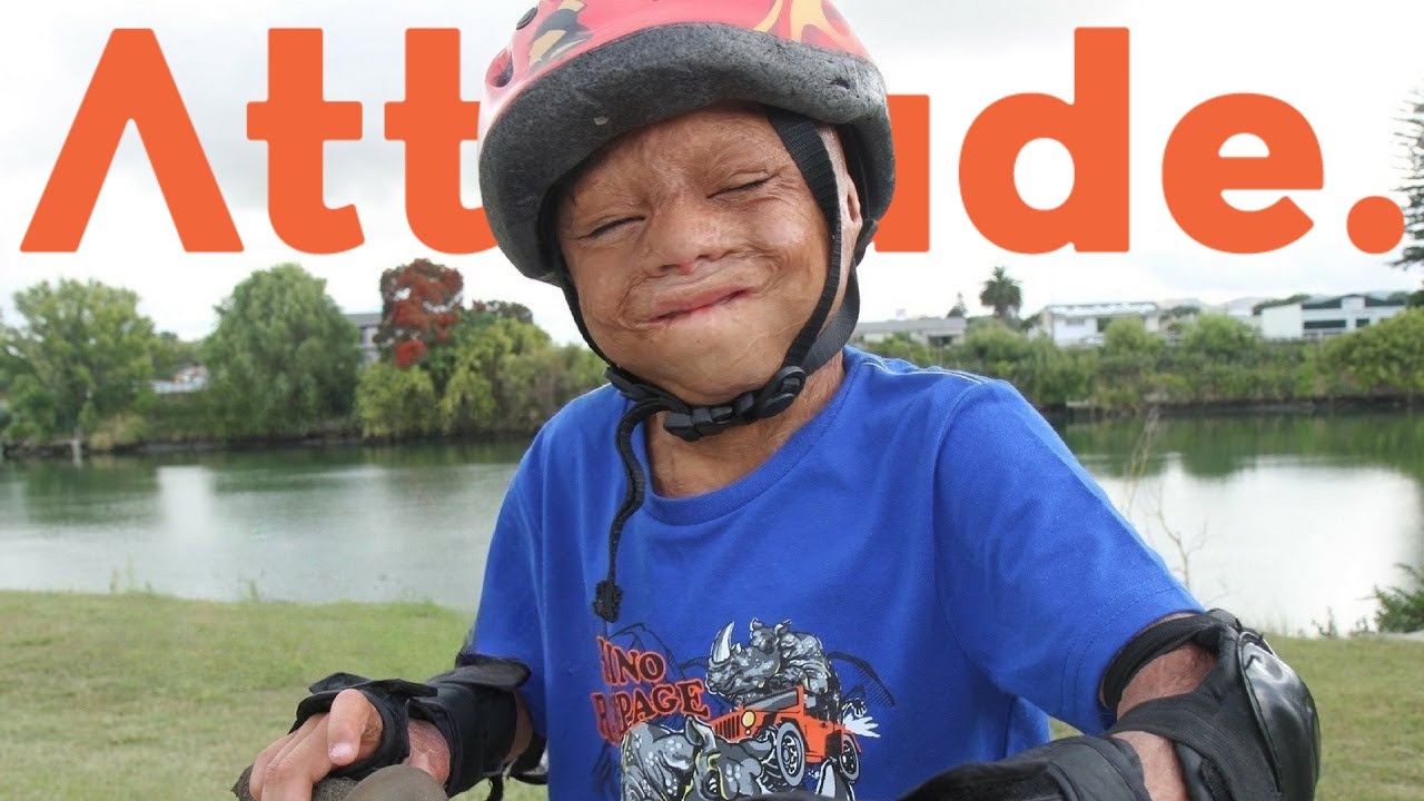 Burns Survivor: Dukie's Story