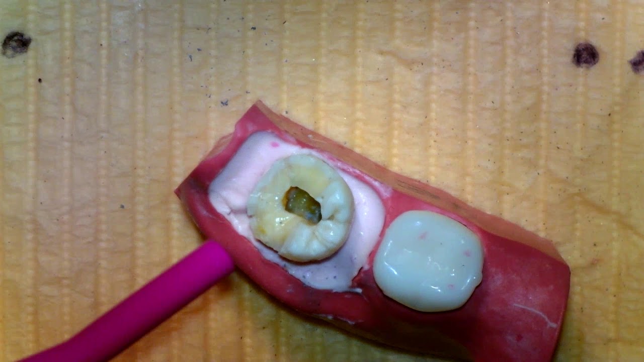 Установка заднего готового штифта