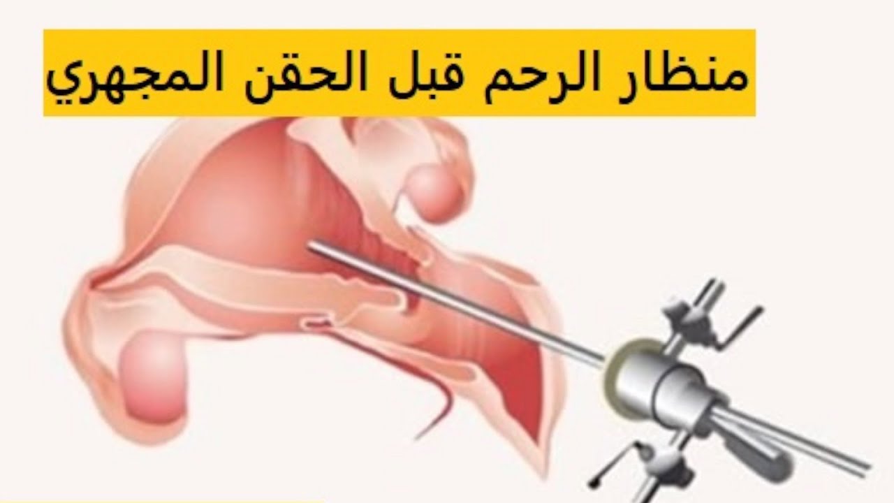 منظار الرحم قبل الحقن المجهري