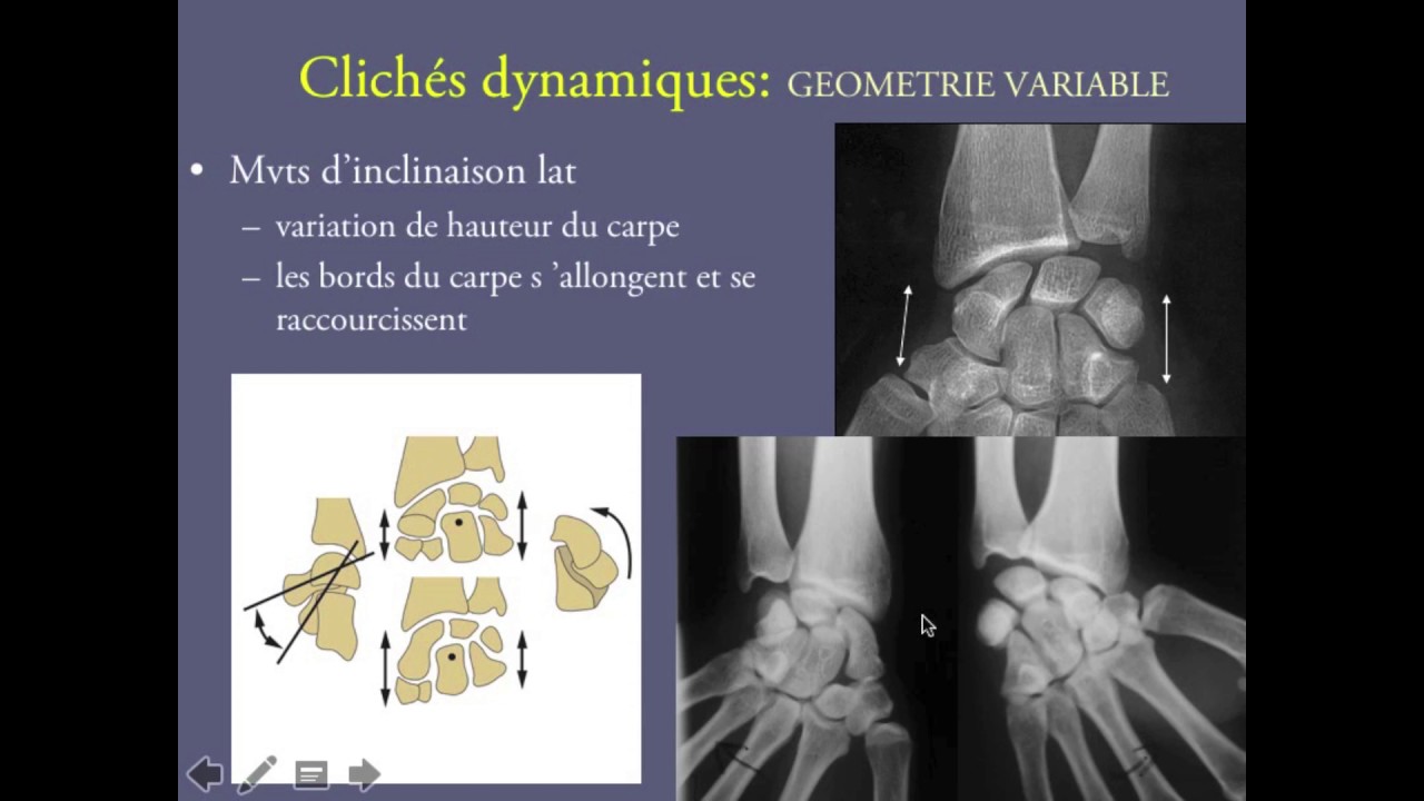 Imagerie du poignet traumatique partie 1 (Caroline Parlier MD)