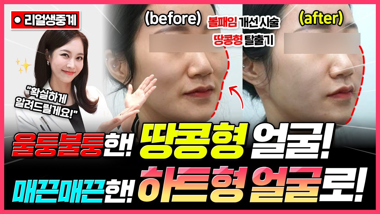 요즘 얼굴형 트렌드는 하트라인❓💖땅콩형 탈출의 모든것 알려드립니다❗👀