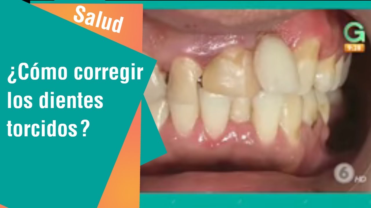 ¿Cómo corregir los dientes torcidos? | Salud