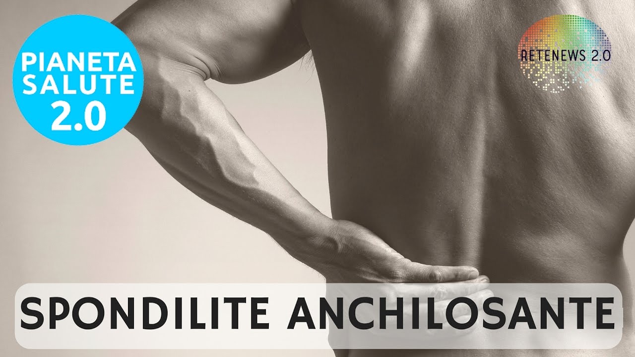 La Spondilite anchilosante: sintomi, cause, impatto, decorso e cura. PIANETA SALUTE 2.0