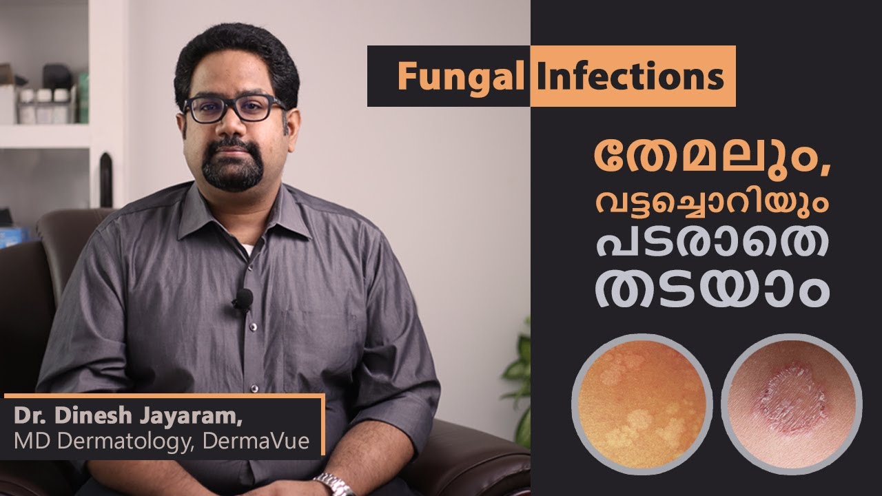 FUNGAL INFECTIONS OF SKIN | തേമലും, വട്ടച്ചൊറി (fungus) രോഗങ്ങളെ എങ്ങനെ  തടയാം #malayalamhealthtips