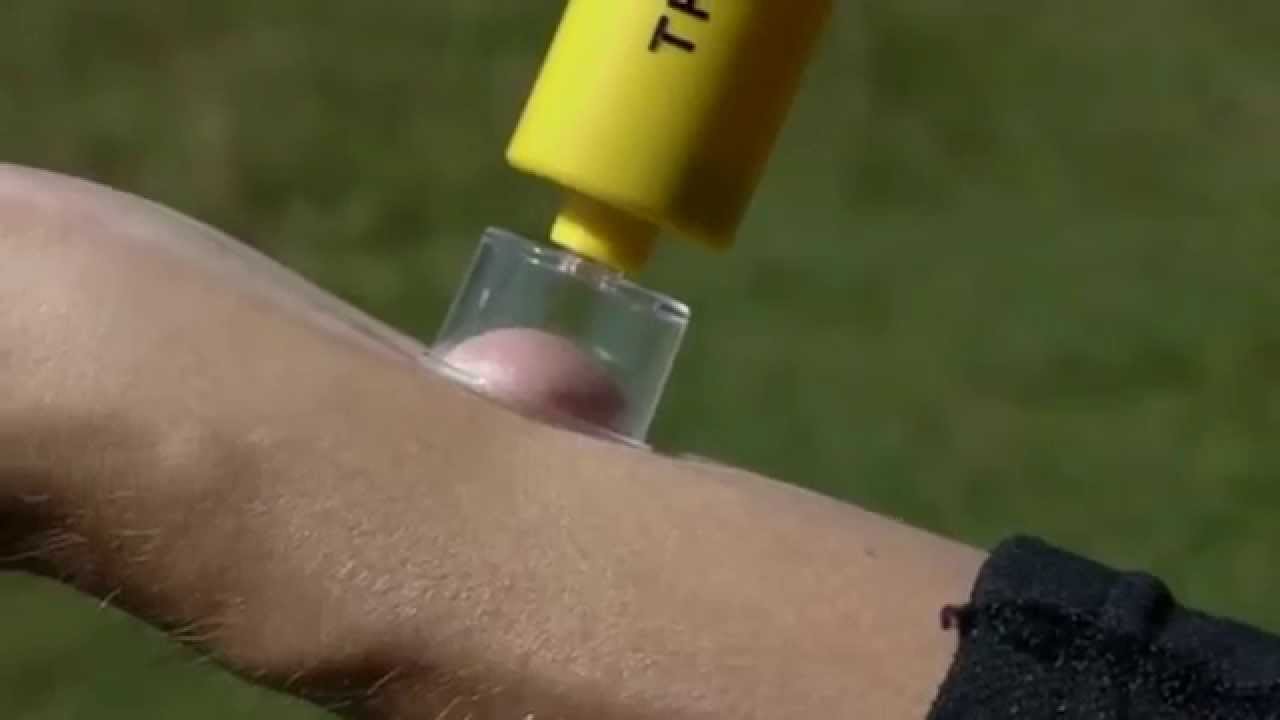Sawyer Snake Bite & Insect Sting Kit
