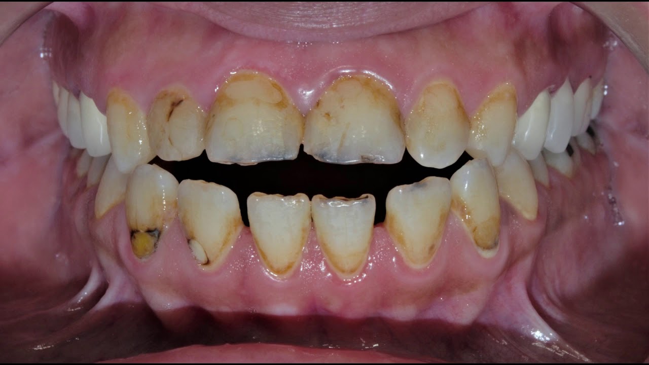 حاله تجميل الاسنان بالتقويم وتركيبات الايماكس الدكتور معتز سليمان