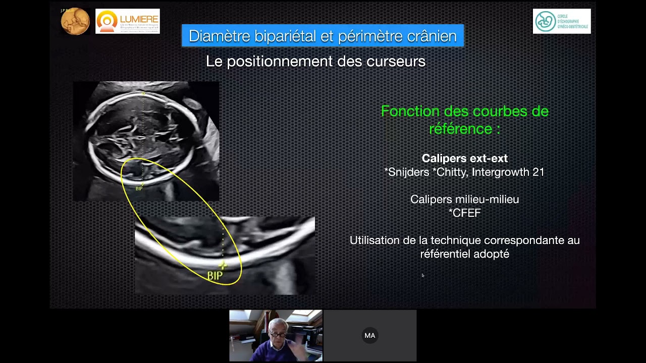 BIOMÉTRIE FOETALE: BIEN MESURER - ÉCHOGRAPHIE OBSTÉTRICALE