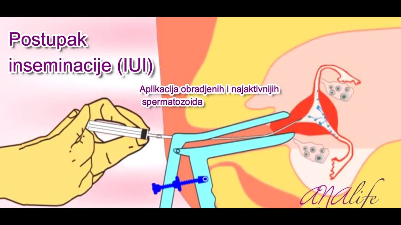 Kako izgleda postupak inseminacije (IUI)-Analife