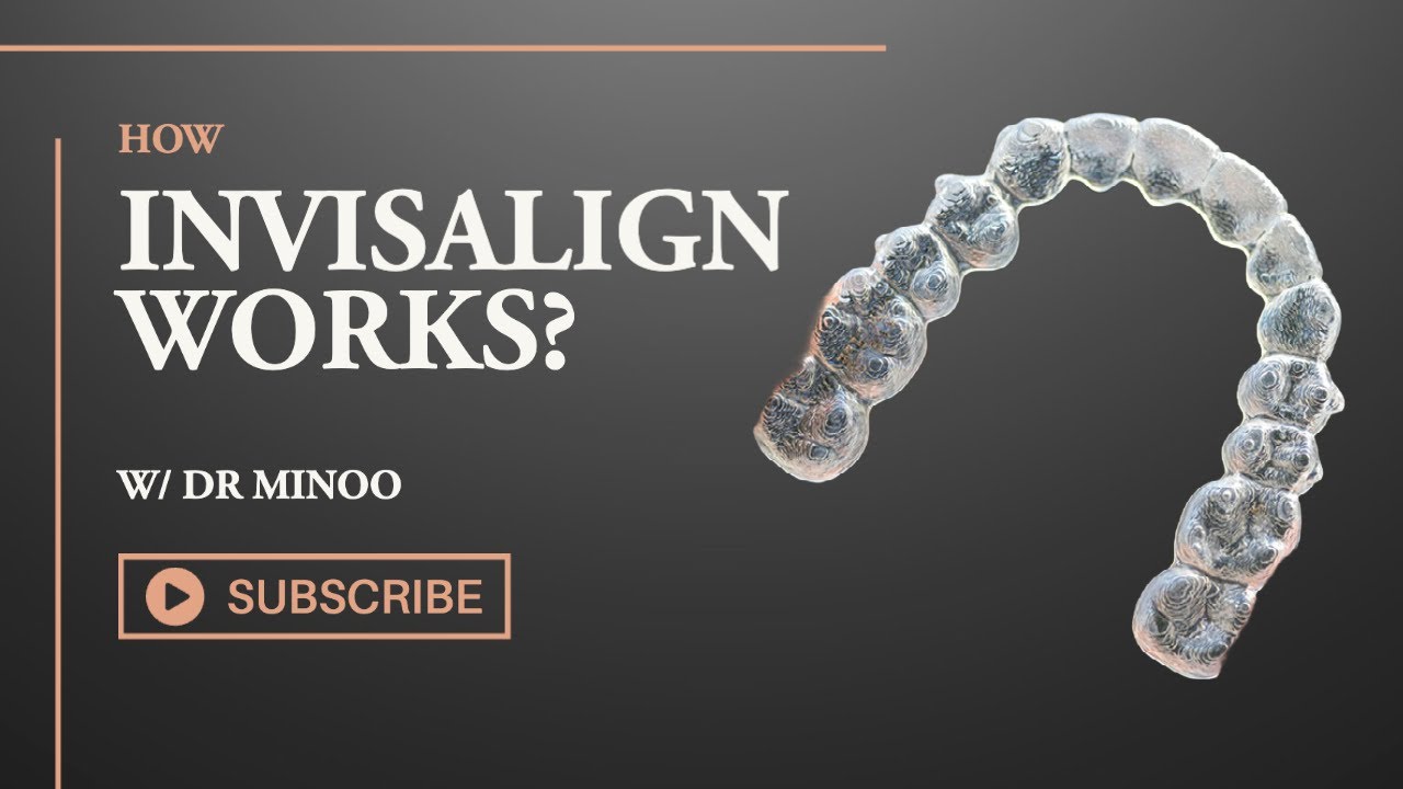 Invisalign and How it Actually Works! (The Complete Guide)