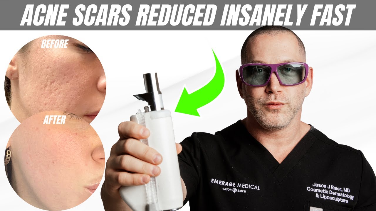 BYE-BYE Acne Scars: Reducing Acne Scars with LASERS | Dr. Jason Emer