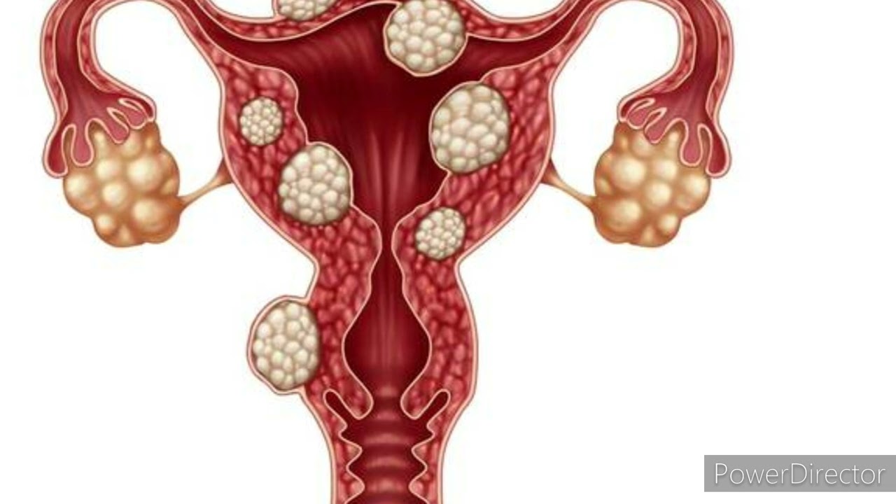 ENDOMETRIOSIS   😳 KUDHACO MAKAANKA WAXBADAN KA OGOOW HADA TAHAY GABAR UURKA KA SODAHAY