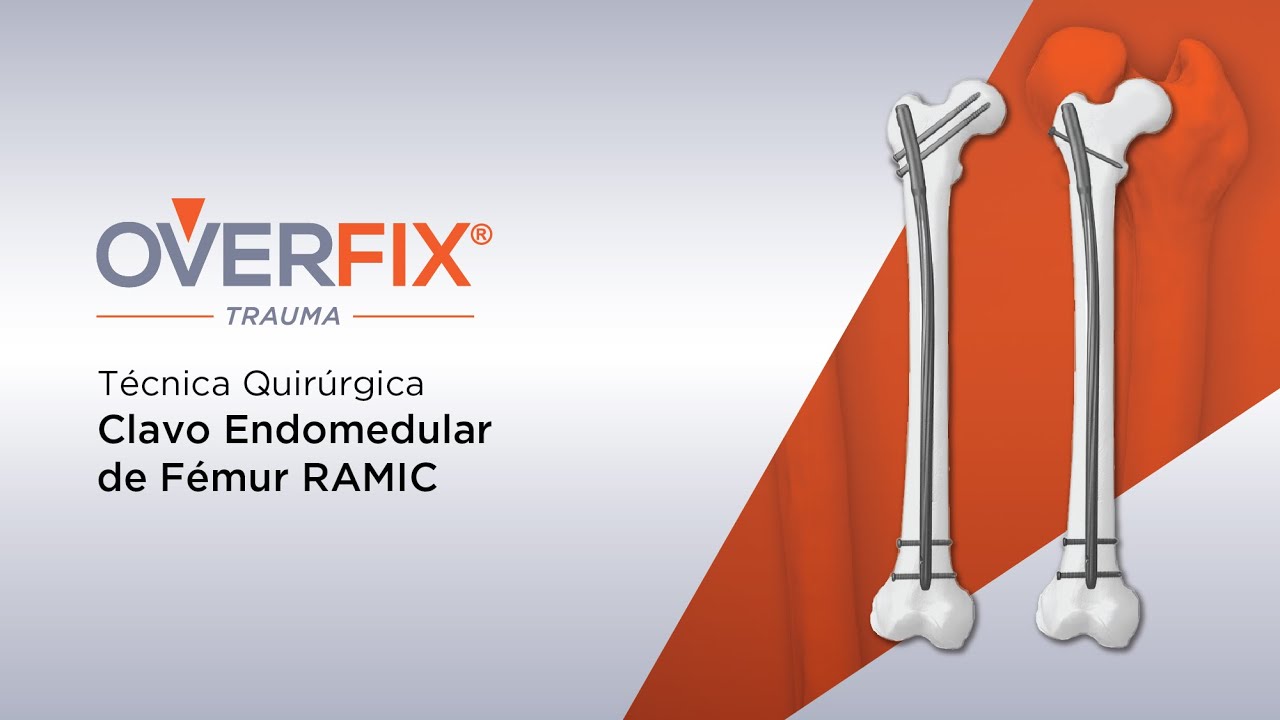 Técnica Quirúrgica Clavo Endomedular de Fémur Overfix RAMIC