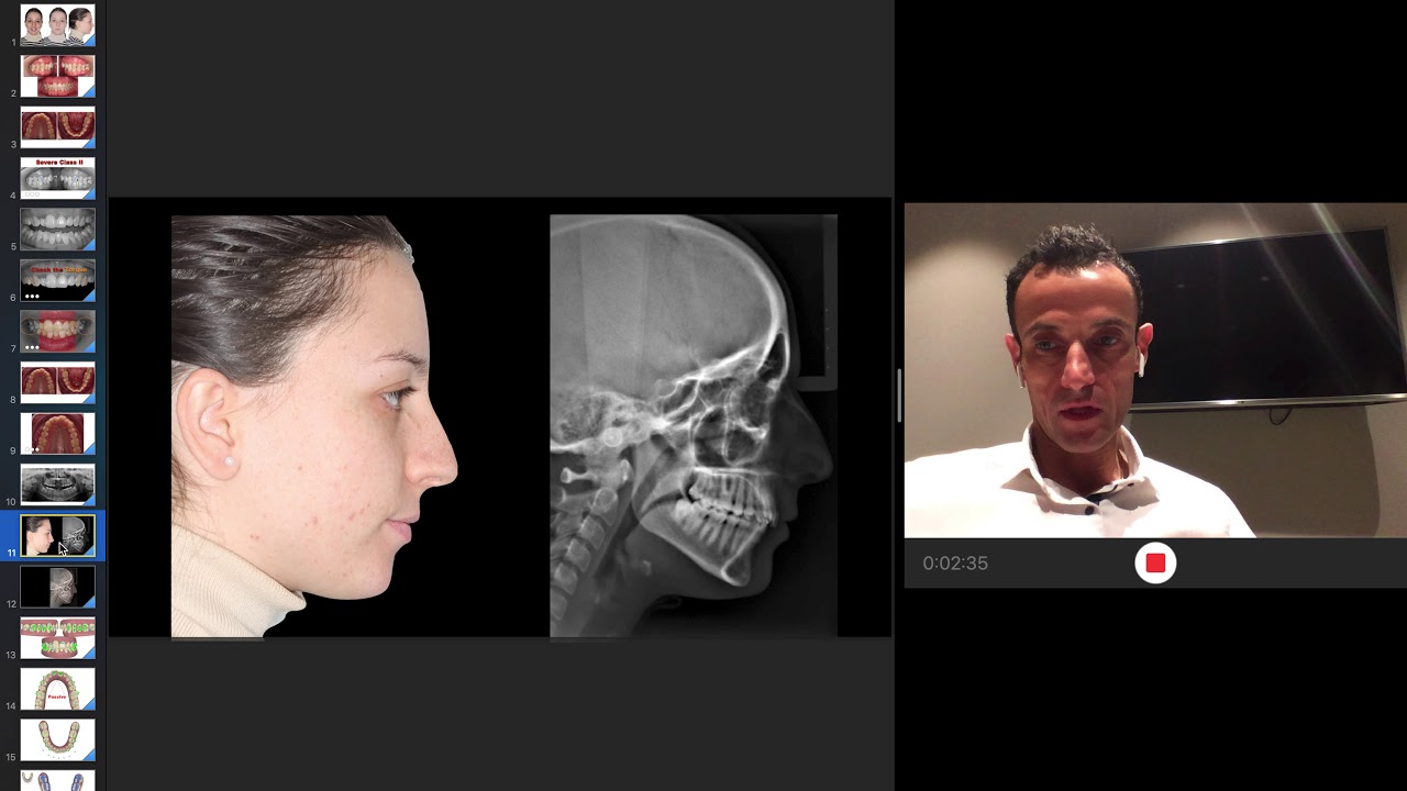 protocols  to solve a severe Class II with aligners and IZC screws