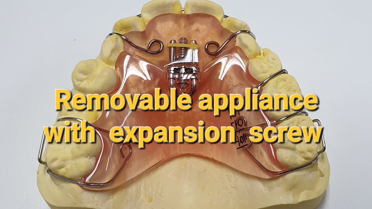 Expansion screw/ Removable appliances with expansion screw/악궁확장장치