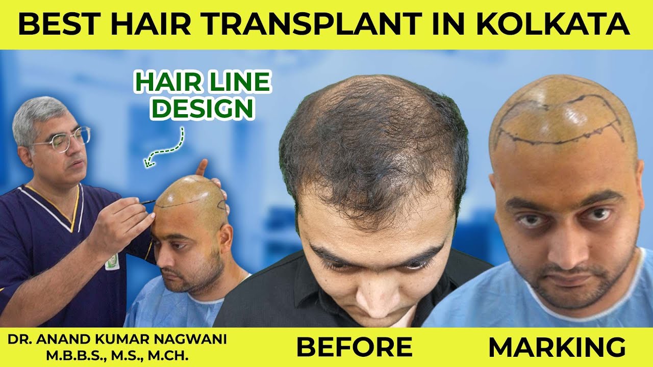 Best Hair transplant in Kolkata | FUT | Detailed Hairline Design by Dr. Nagwani | Calcutta Cosmo aid