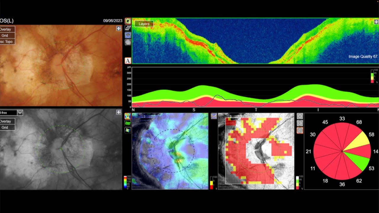 Glaucoma de Tensión Normal