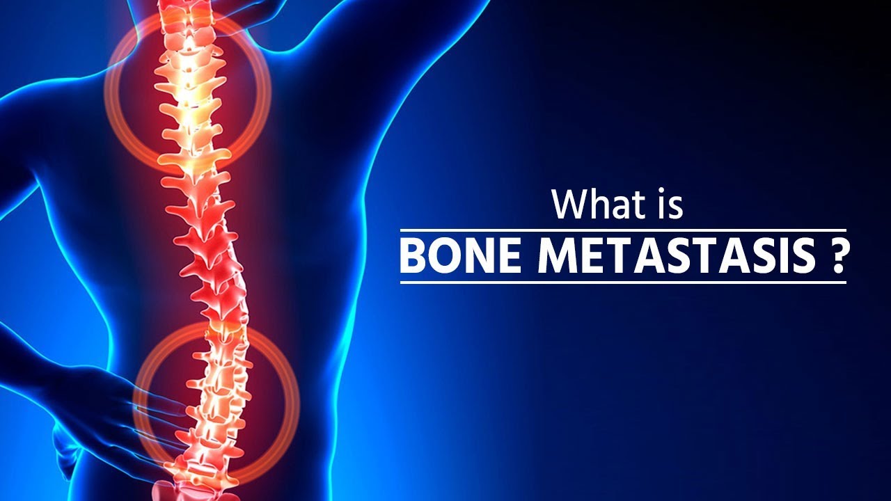 What is bone metastasis | Stage 4 Cancer | Bone Metastasis | How Cancer Spreads | metastasis |