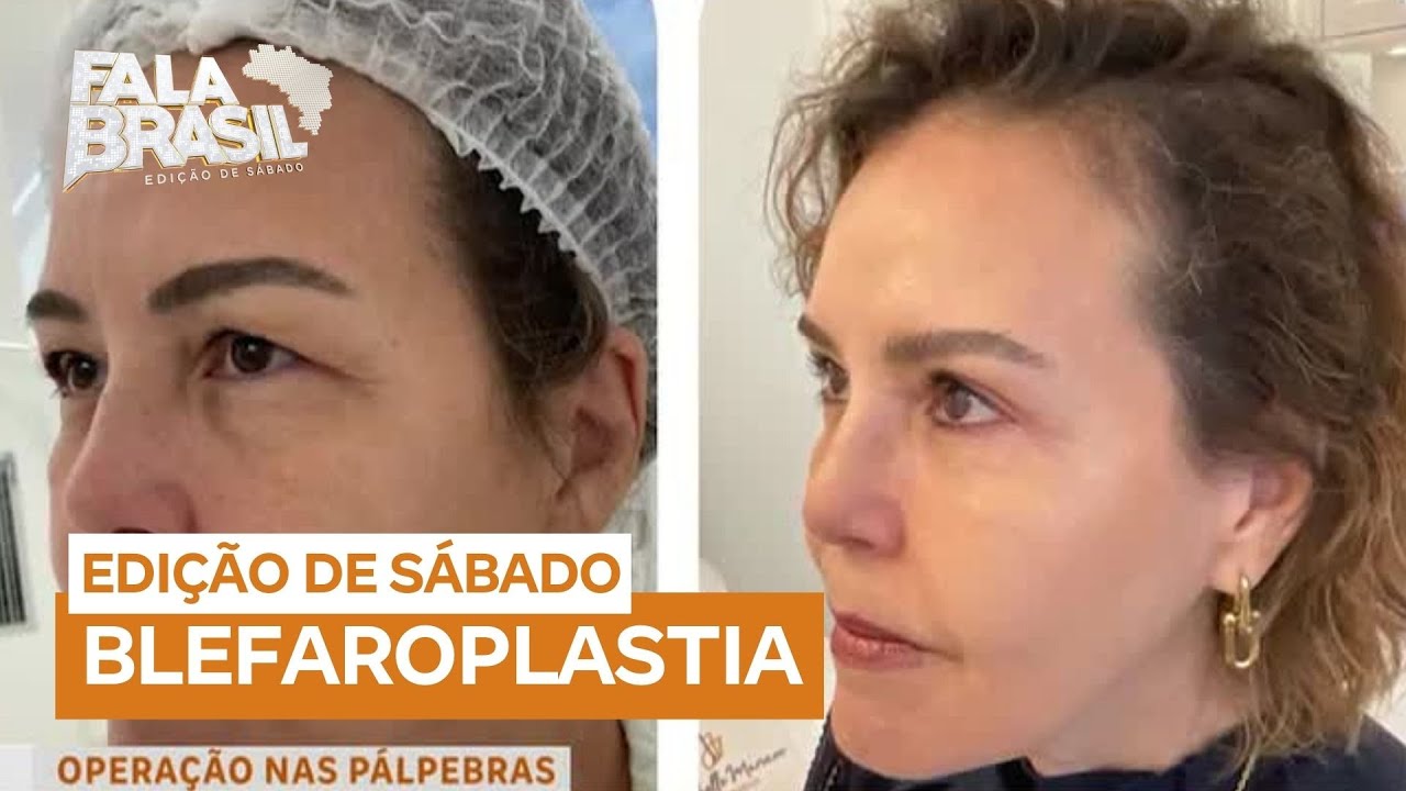 Blefaroplastia: cirurgia das pálpebras cresce em popularidade por estética e saúde
