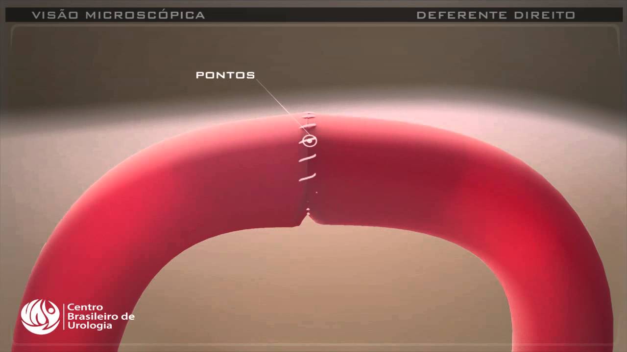 Reversão Vasectomia