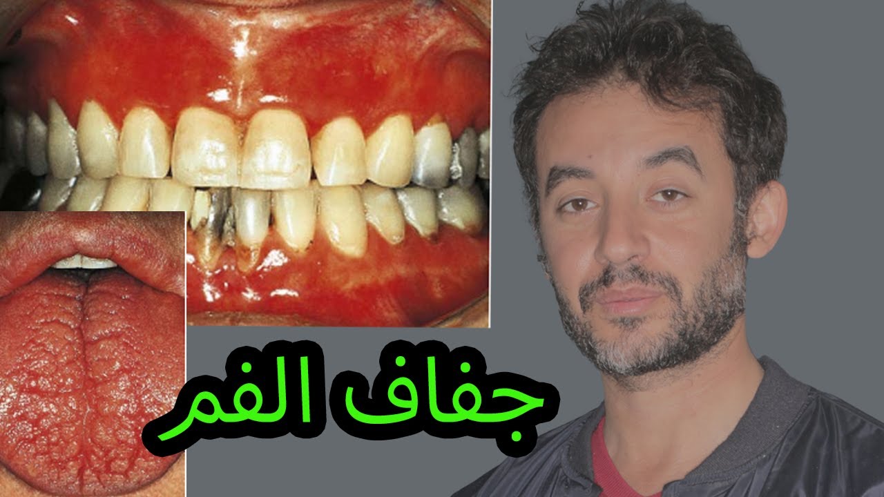 إزاى عالجت حالة جفاف الفم sjogrens syndrome