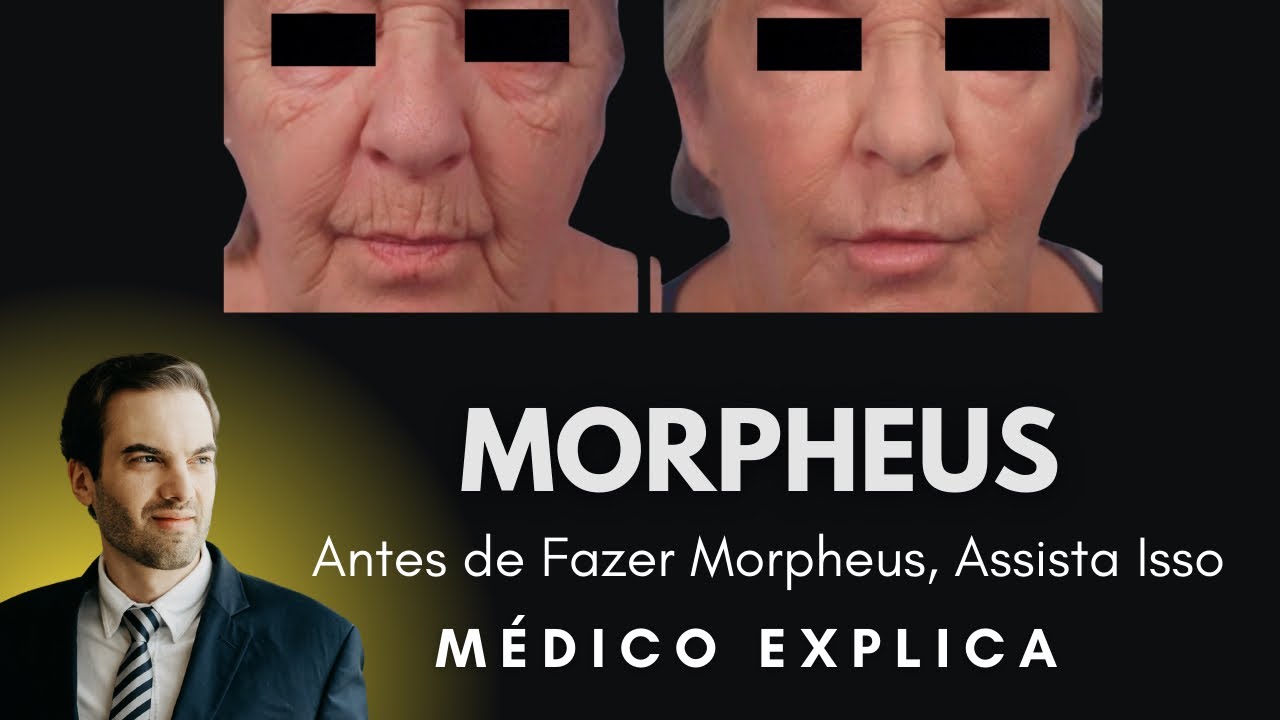 Morpheus: Tudo o Que Você Precisa Saber  Procedimento, Anestesia, Valores e Resultados
