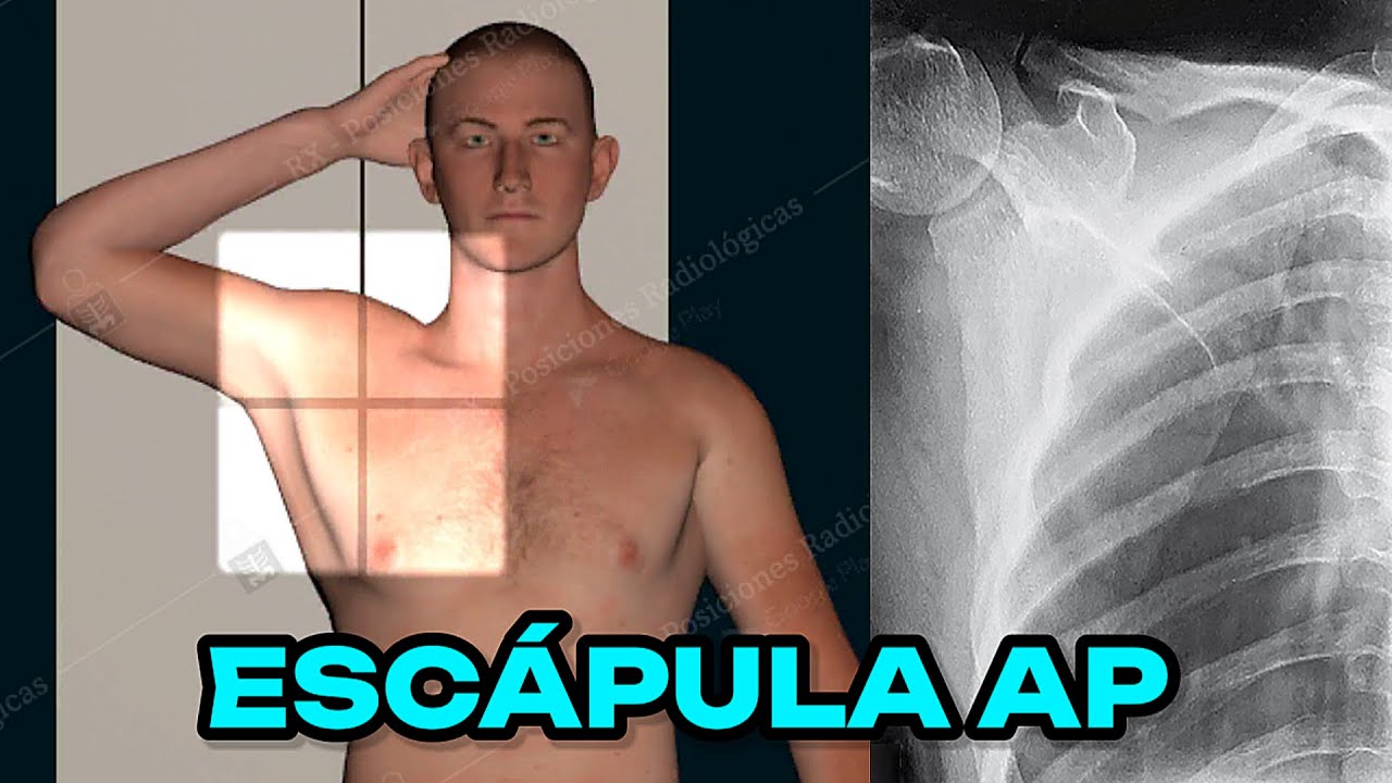 RADIOGRAFÍA DE ESCÁPULA U OMÓPLATO AP (MANUAL DE BOLSILLO) #36